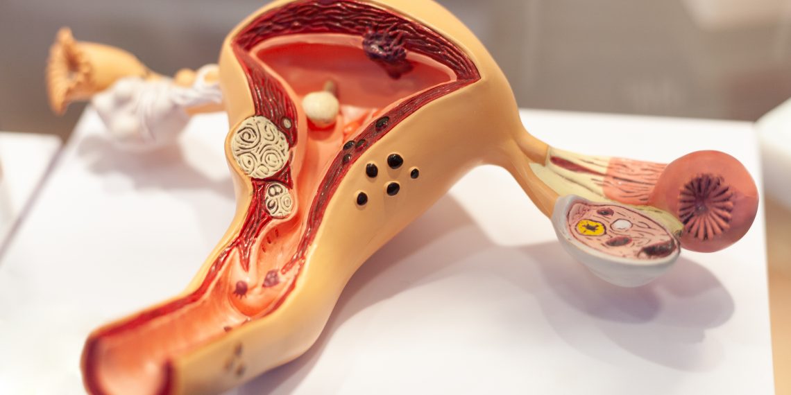 גידול ברחם טיפול נוסף שכדאי לשלב