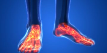 בעיות רגליים והליכה