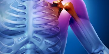 בעיות כתפיים