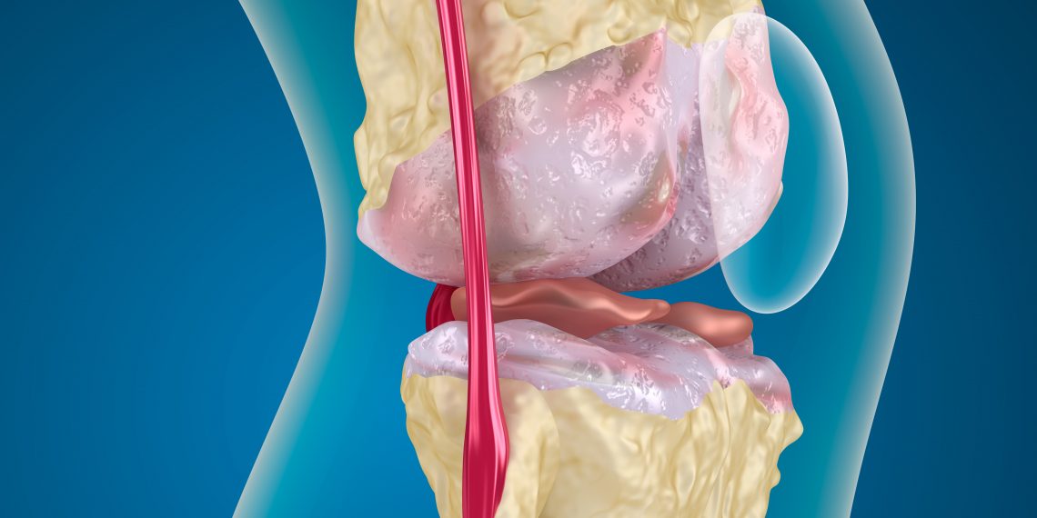 אוסטאופורוזיס